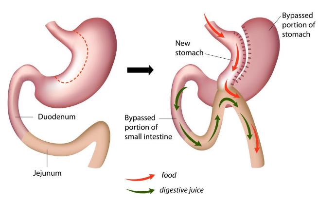 A diagram of a stomach showing the pathway for food and digestive juice